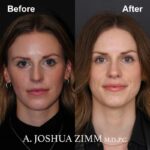 Rhinoplasty - before and after