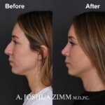 Rhinoplasty - before and after