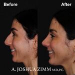 Chin implant - before and after