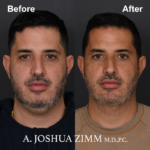 Chin implant - before and after