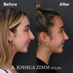 Chin implant - before and after