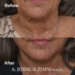 Facelift - before and after