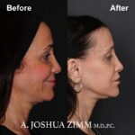 Facelift - before and after