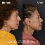 Facelift - before and after