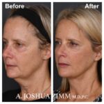 Facelift - before and after