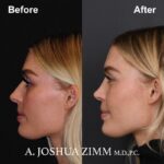 Rhinoplasty - before and after