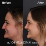 Rhinoplasty - before and after