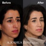 Rhinoplasty - before and after