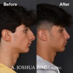 Rhinoplasty - before and after