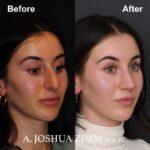 Rhinoplasty - before and after