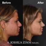 Rhinoplasty - before and after