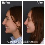 Rhinoplasty - before and after