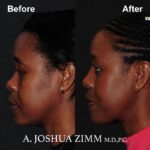 Rhinoplasty - before and after