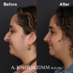 Rhinoplasty - before and after