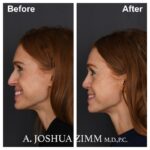 Rhinoplasty - before and after