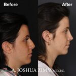 Rhinoplasty - before and after