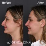 Rhinoplasty - before and after