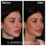 Rhinoplasty - before and after