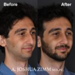 Rhinoplasty - before and after