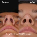 Rhinoplasty - before and after