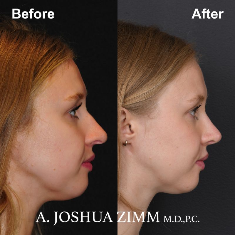 Rhinoplasty - before and after