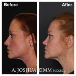 Rhinoplasty - before and after