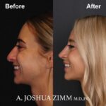 Rhinoplasty - before and after