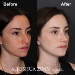 Rhinoplasty - before and after