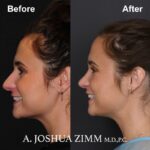 Rhinoplasty - before and after