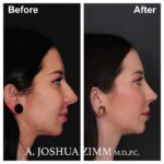 Rhinoplasty - before and after