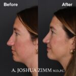 Rhinoplasty - before and after