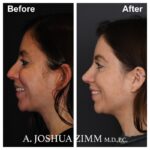 Rhinoplasty - before and after