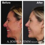 Rhinoplasty - before and after