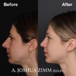 Rhinoplasty - before and after