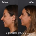 Rhinoplasty - before and after