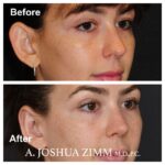 Rhinoplasty - before and after