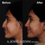 Rhinoplasty - before and after