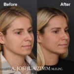 Rhinoplasty - before and after