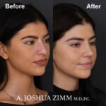 Rhinoplasty - before and after