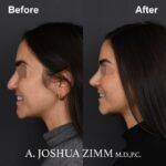 Rhinoplasty - before and after