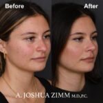 Rhinoplasty - before and after