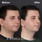 Rhinoplasty - before and after