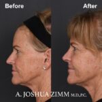 Rhinoplasty - before and after