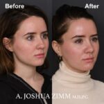 Rhinoplasty - before and after