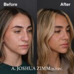 Rhinoplasty - before and after