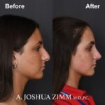 Rhinoplasty - before and after