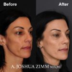 Rhinoplasty - before and after