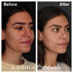 Rhinoplasty - before and after