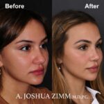 Rhinoplasty - before and after