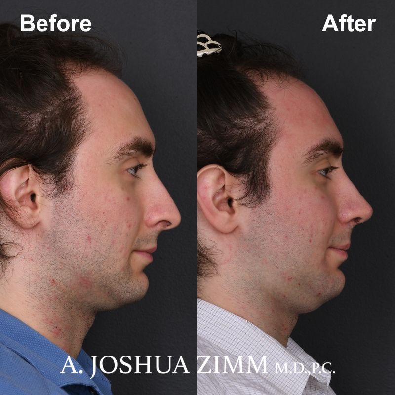 Rhinoplasty - before and after